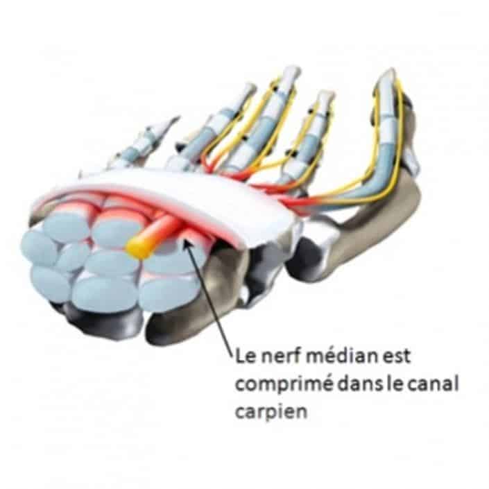 canal-carpien-reseau-main-nerf-median-compression-5