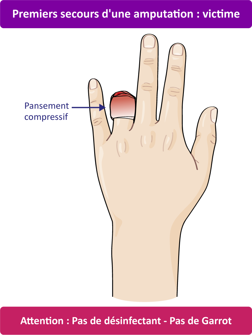 amputation d'un doigt
