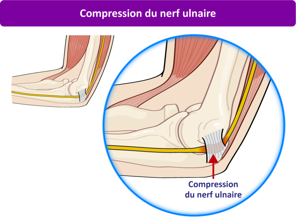 Compression du nerf ulnaire