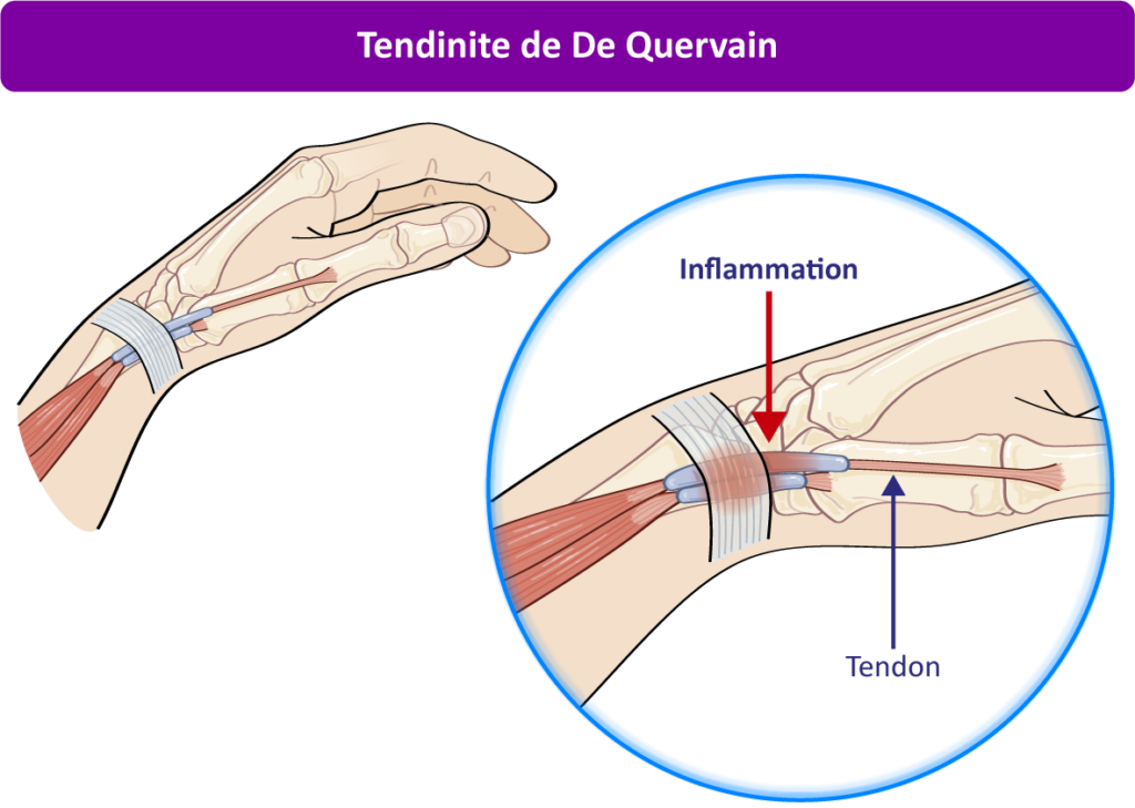 Tendinite de De Quervain